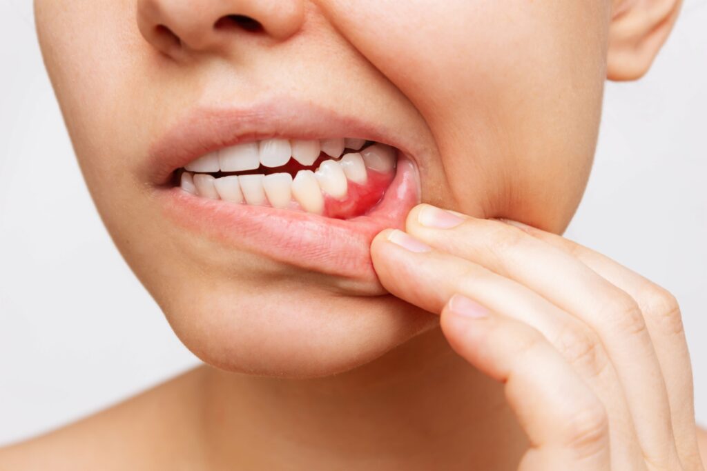 How to Spot Signs of Gum Disease?